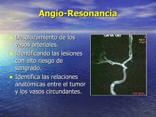 Angio-Resonancia Desplazamiento de los vasos arteriales. Identificando las lesiones con alto riesgo de sangrado. Identifica las relaciones anatómicas entre el tumor y los vasos circundantes. 