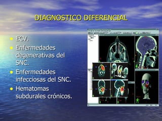DIAGNOSTICO DIFERENCIAL ECV. Enfermedades degenerativas del SNC. Enfermedades infecciosas del SNC. Hematomas subdurales crónicos. 