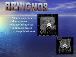 Adenomas pituitarios. Meningiomas. Craneofaringiomas. Tumores pineales. Hemangioblastomas. BENIGNOS 