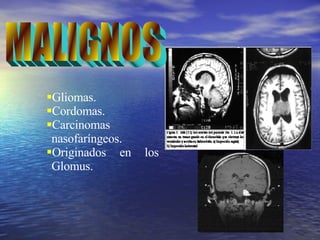 Gliomas. Cordomas. Carcinomas  nasofaríngeos. Originados en los  Glomus. MALIGNOS 