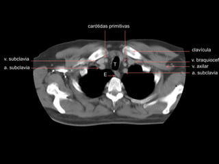 v. braquiocef
T
a. subclavia
v. subclavia
v. axilar
clavícula
E
a. subclavia
carótidas primitivas
 