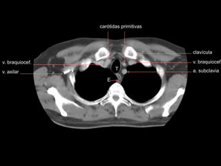 v. braquiocef.
T
E
carótidas primitivas
a. subclavia
v. braquiocef.
v. axilar
clavícula
 