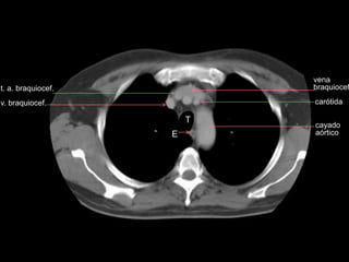 vena
braquiocef
T
E
cayado
aórtico
carótida
t. a. braquiocef.
v. braquiocef.
 