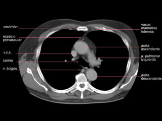 esternón
v.c.s.
carina
v. ácigos
espacio
prevascular
aorta
ascendente
a. pulmonar
izquierda
aorta
descendente
vasos
mamarios
internos
 