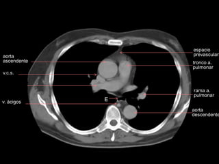 aorta
ascendente
v.c.s.
a. pulmonar
derecha
espacio
prevascular
tronco a.
pulmonar
aorta
descendente
v. ácigos E
rama a.
pulmonar
 