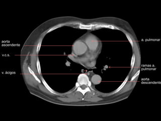 a. pulmonar
v.c.s.
v. ácigos
ramas a.
pulmonar
E
aorta
ascendente
aorta
descendente
 