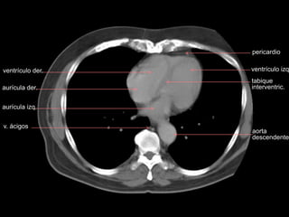 ventrículo der.
aurícula izq.
v. ácigos
aurícula der.
aorta
descendente
ventrículo izq
tabique
interventric.
pericardio
 