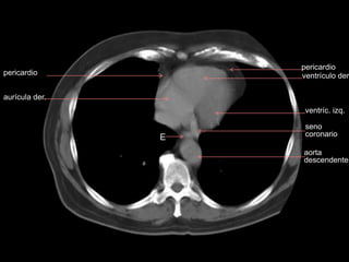 aurícula der.
ventrículo der.
ventríc. izq.
E
pericardio
pericardio
aorta
descendente
seno
coronario
 