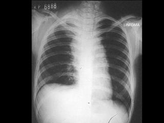 LINFOMA
 