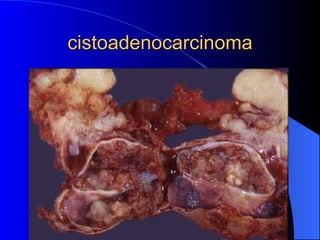 cistoadenocarcinoma 