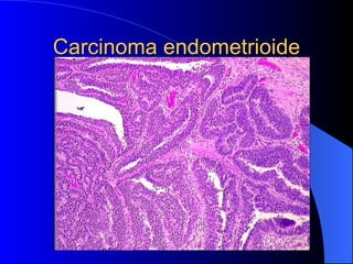 Carcinoma endometrioide 