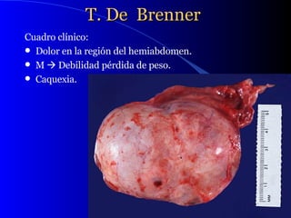 T. De  Brenner   Cuadro clínico: Dolor en la región del hemiabdomen. M    Debilidad pérdida de peso. Caquexia.  
