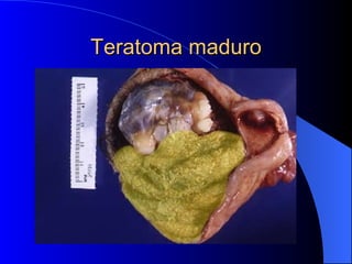 Teratoma maduro 