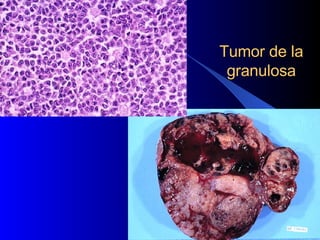 Tumor de la granulosa 