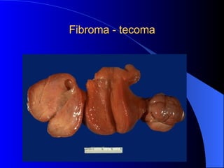 Fibroma - tecoma 