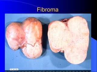 Fibroma  