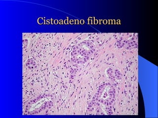 Cistoadeno fibroma 