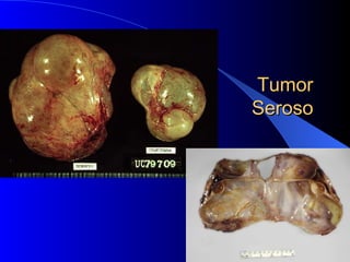 Tumor Seroso  