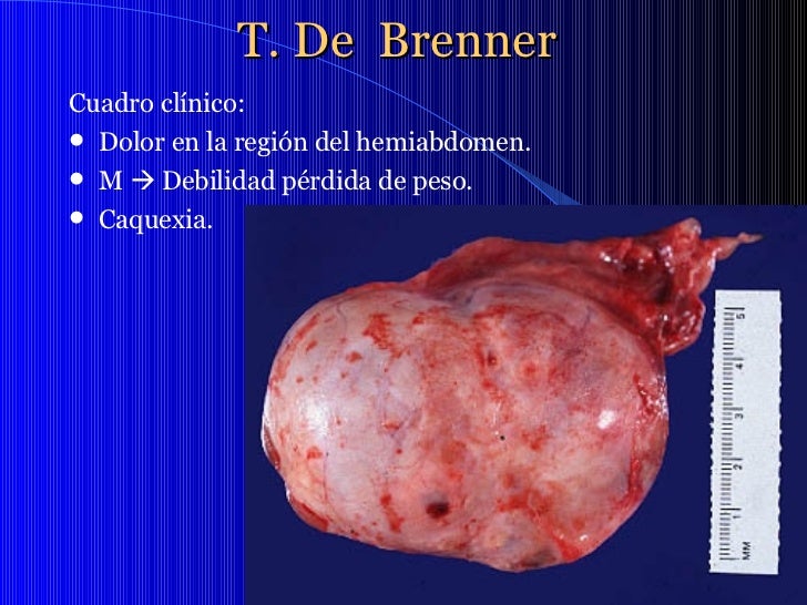 TUMORES DE OVARIO EBOOK DOWNLOAD TUMORES DE OVARIO EBOOK DOWNLOAD