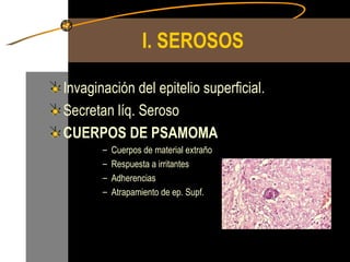I. SEROSOS Invaginación del epitelio superficial. Secretan líq. Seroso CUERPOS DE PSAMOMA Cuerpos de material extraño Respuesta a irritantes Adherencias Atrapamiento de ep. Supf. 