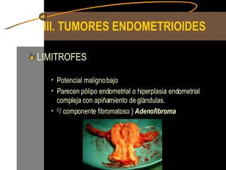 III. TUMORES ENDOMETRIOIDES LIMITROFES Potencial maligno bajo Parecen pólipo endometrial o hiperplasia endometrial compleja con apiñamiento de glándulas. C / componente fibromatoso }  Adenofibroma 