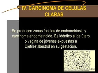 IV. CARCINOMA DE CELULAS CLARAS Se producen zonas focales de endometriosis y carcinoma endometrioide. Es idéntico al de útero o vagina de jóvenes expuestas a Dietilestilbestrol en su gestación. 