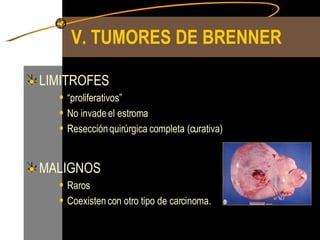 V. TUMORES DE BRENNER LIMITROFES “ proliferativos” No invade el estroma Resección quirúrgica completa (curativa) MALIGNOS Raros Coexisten con otro tipo de carcinoma. 
