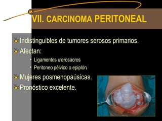 VII.  CARCINOMA  PERITONEAL Indistinguibles de tumores serosos primarios. Afectan: Ligamentos uterosacros Peritoneo pélvico o epiplón. Mujeres posmenopaúsicas. Pronóstico excelente. 