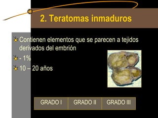 2. Teratomas   inmaduros   Contienen elementos que se parecen a tejidos derivados del embrión - 1% 10 – 20 años GRADO III GRADO II GRADO I 
