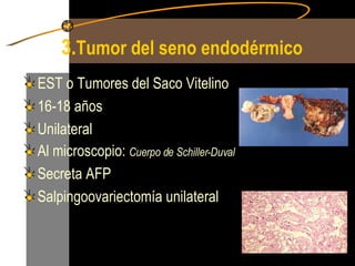3. Tumor del seno endodérmico EST o Tumores del Saco Vitelino 16-18 años Unilateral Al microscopio:  Cuerpo de Schiller-Duval Secreta AFP Salpingoovariectomía unilateral 