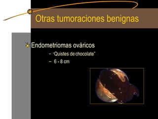 Otras tumoraciones benignas Endometriomas ováricos “ Quistes de chocolate” 6 - 8 cm 