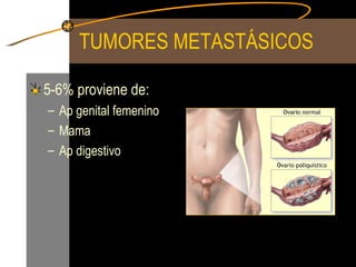 TUMORES METASTÁSICOS 5-6% proviene de:  Ap genital femenino Mama Ap digestivo 