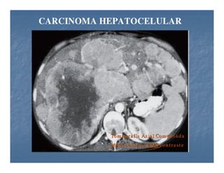 Tumores Hepaticos