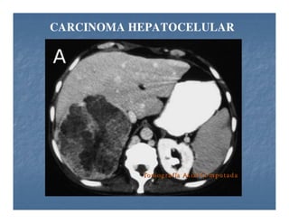 Tumores Hepaticos