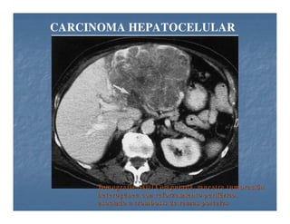 Tumores Hepaticos