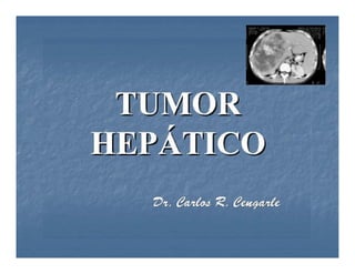 Tumores Hepaticos