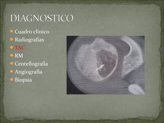 Cuadro clínico
Radiografias
TAC
RM
Centellografia
Angiografía
Biopsia
 