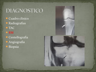 Cuadro clínico
Radiografias
TAC
RM
Centellografia
Angiografía
Biopsia
 
