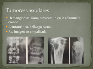 Hemangiomas: Raro, más común en la columna y
cráneo
Asintomático, hallazgo casual
Rx. Imagen en empalizada
 