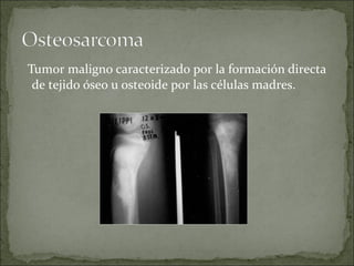 Tumor maligno caracterizado por la formación directa
de tejido óseo u osteoide por las células madres.
 