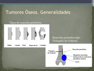Tumores Óseos. Generalidades
•
• Tipos de reacción perióstica
•
•
•
•
•
•
• Reacción perióstica tipo
Triángulo de Codman
•
 