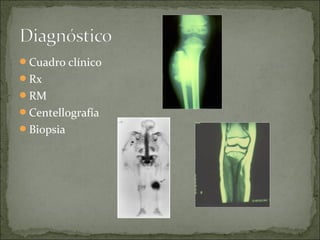 Cuadro clínico
Rx
RM
Centellografía
Biopsia
 