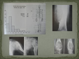 Tumores oseos-upap