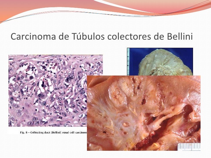 Tumores Renales Tumores Renales