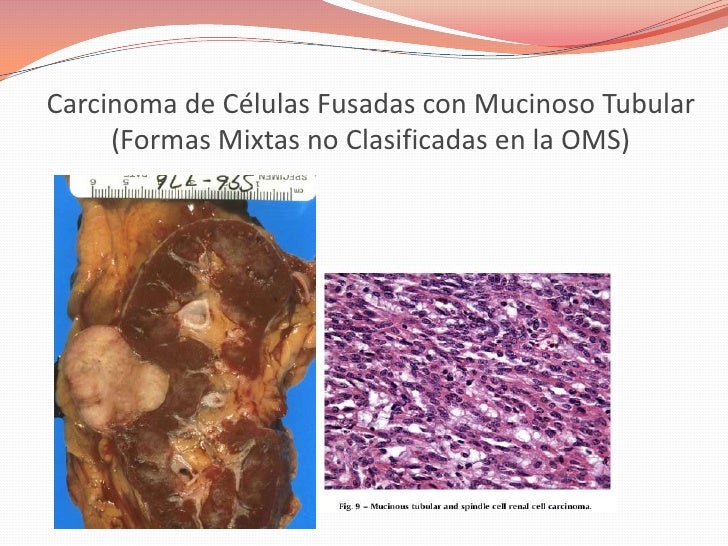 Tumores Renales