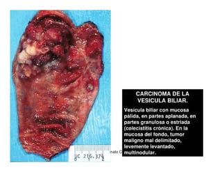 Tumores Vía Biliar