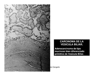 Tumores Vía Biliar