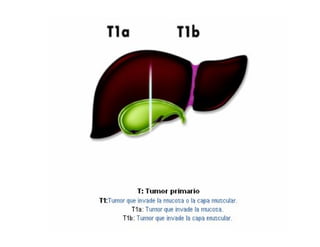 Tumores Vía Biliar