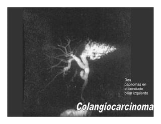 Tumores Vía Biliar