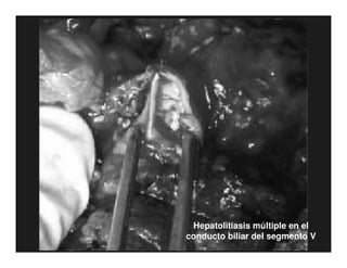 Tumores Vía Biliar